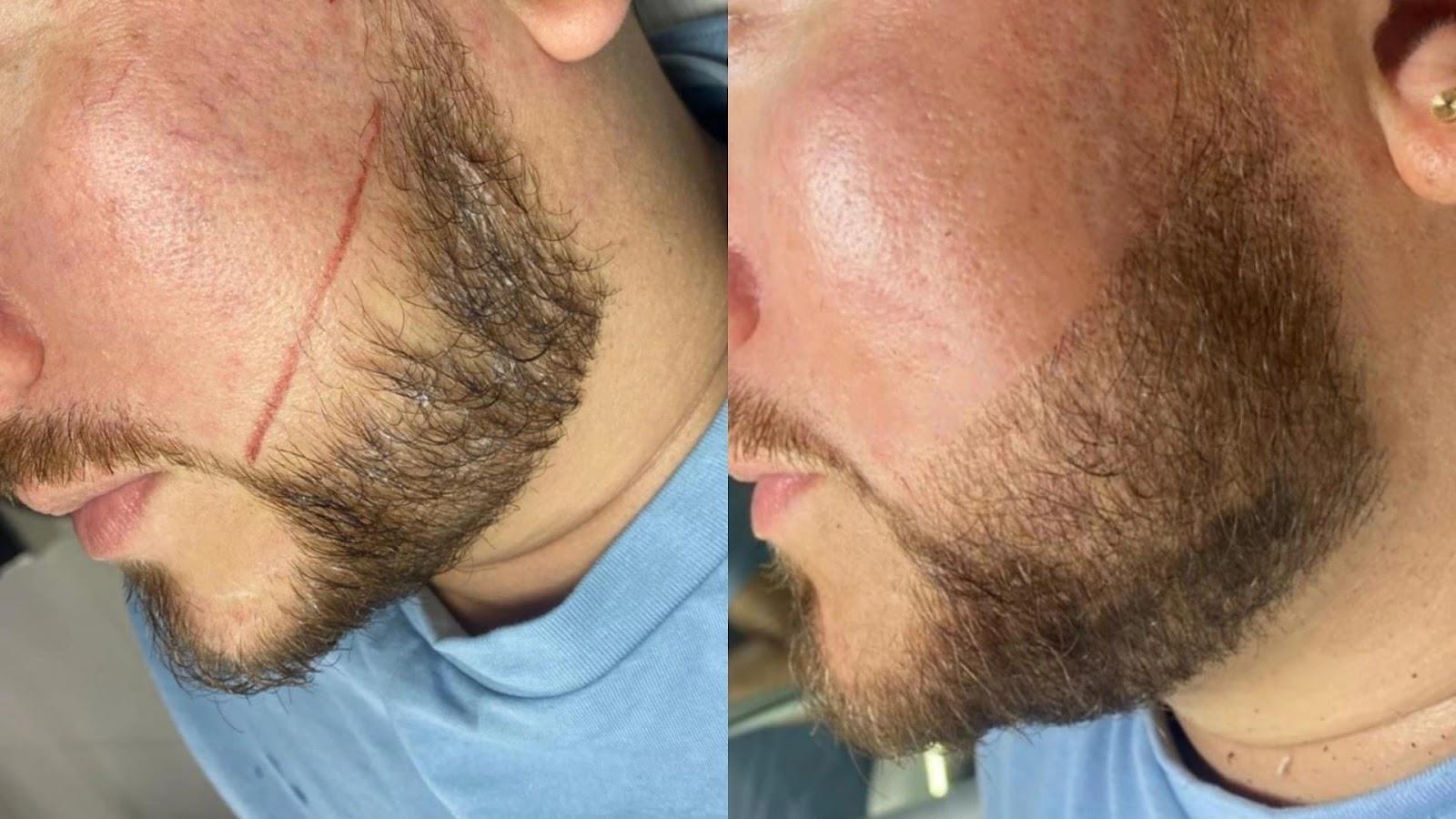 Micropigmentación de barba, antes y después