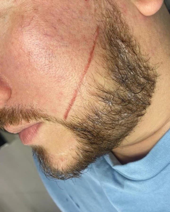 Trazo previo a la micropigmentación de barba